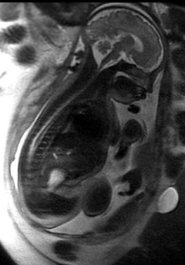 Magnetic resonance image of a fetus at 36 weeks gestation. 